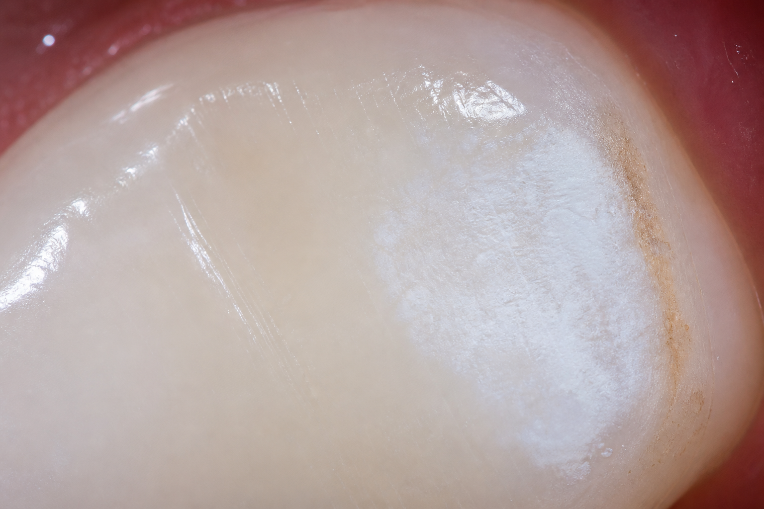 What Dental Caries Look Like Before They Hurt 1 Close-up of tooth enamel showing a matte white patch next to smooth glossy enamel and a faint tan edge.